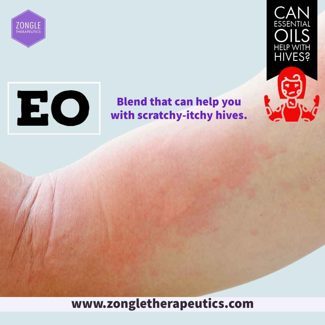Can Essential Oils Help With Hives? Zongle Therapeutics